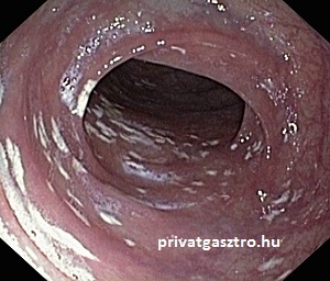 pseudolipomatosis vastagbélnyálkahártyán kolonoszkópia során