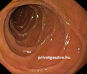 gyomortükrözés duodenum leszálló szára