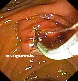 endoscopos sphincterotomia ERCP