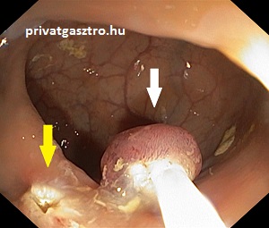 polipektómai vastagbéltükrözés